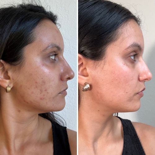 Peau lumineuse & apaisée — Luminothérapie LED Neobody