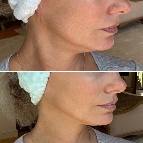 -30% de rides en 4 semaines — Masque LED anti-âge Neobody