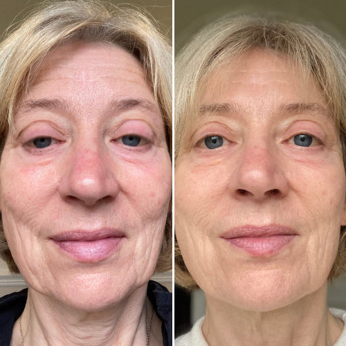 Peau plus ferme & éclat renforcé — Masque LED visage Neobody