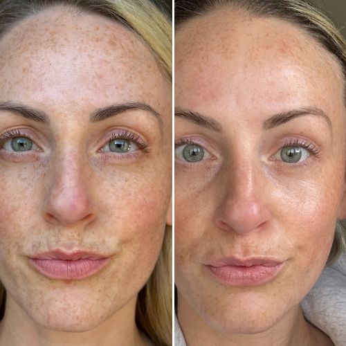 -30% de taches pigmentaires — Masque LED visage Neobody