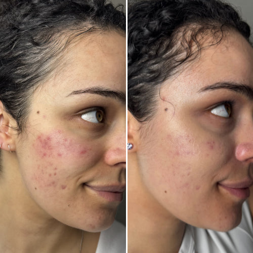 Peau lumineuse & apaisée — Masque LED visage Neobody
